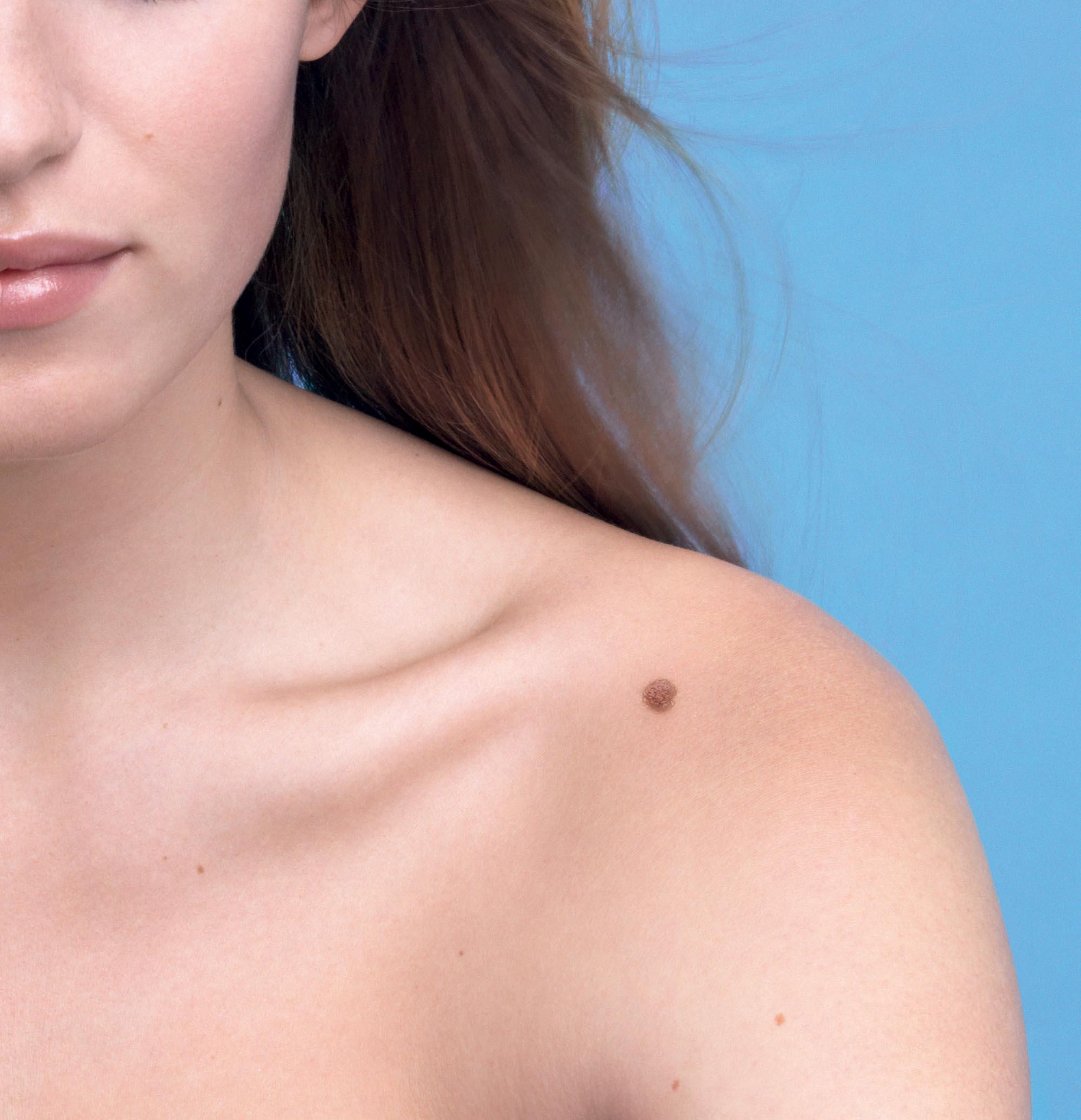 Testari gratuite pentru depistarea melanomulu