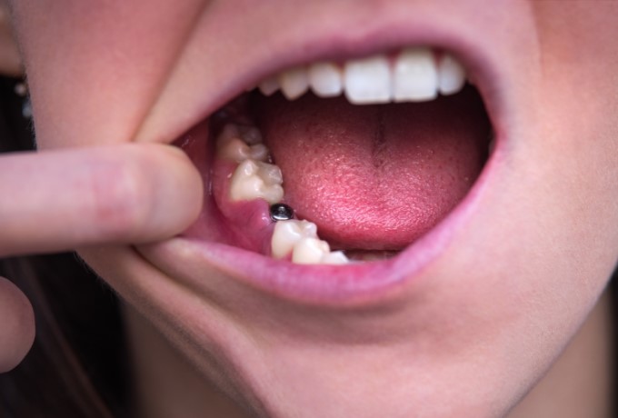 Implanturile dentare - cand se pot recomanda?